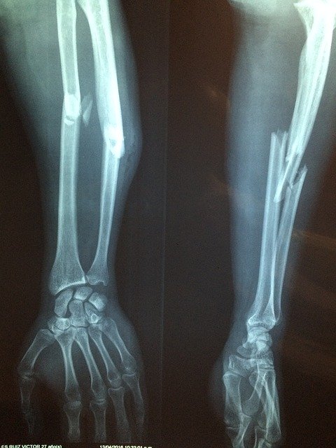 Tips, Tricks And Tweaks For Improved Personal Injury Case Outcomes